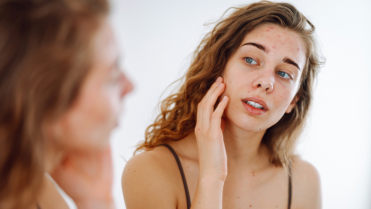 Acne Treatments That Actually Work An Irish Pharmacist’s Guide for Teens & Adults