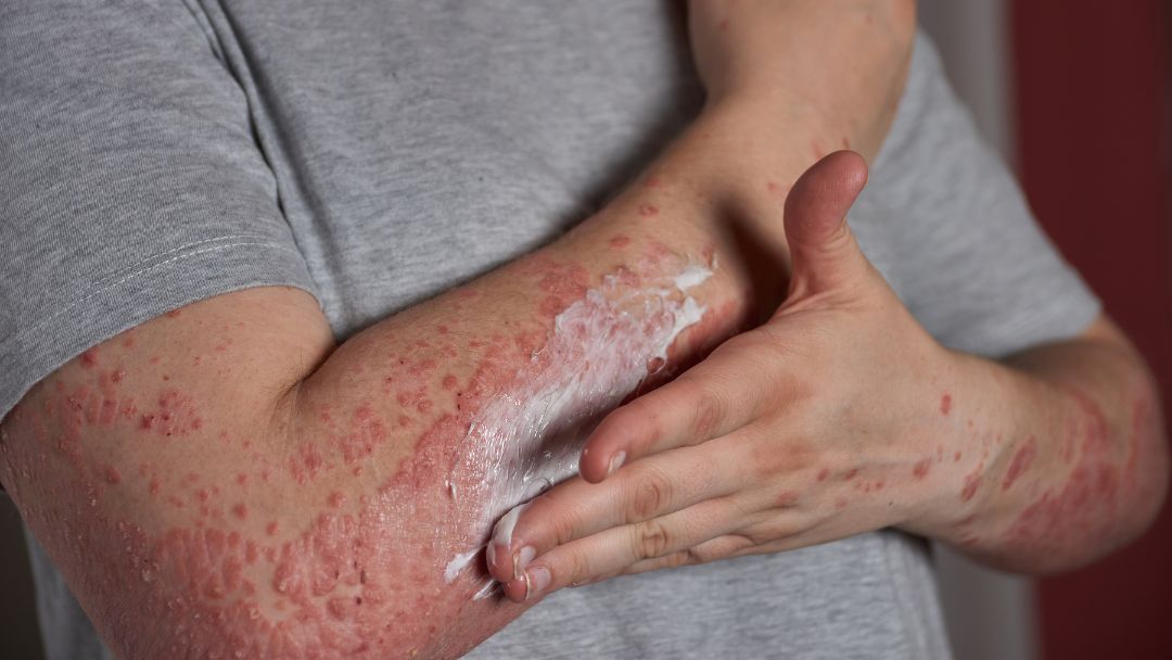 Eczema & Dry Skin in Ireland: Why It Happens and How to Soothe It