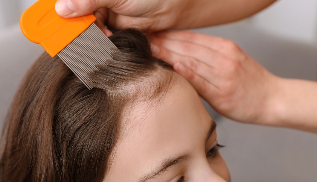 Head Lice in Ireland: How to Spot Them, Treat Them & Stop the Spread