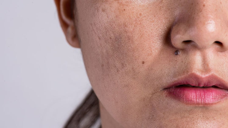 Pigmentation & Dark Spots: Causes, Treatment & Prevention