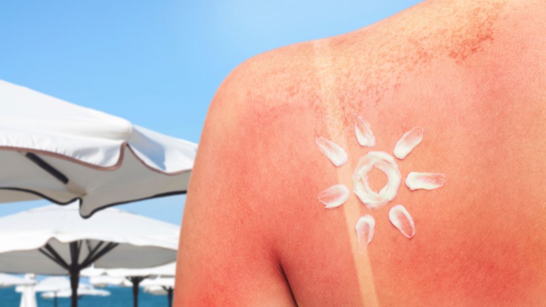 sunburn after sun skincare