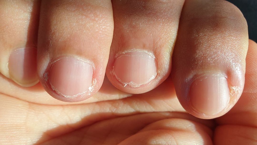 Weak, Brittle Nails