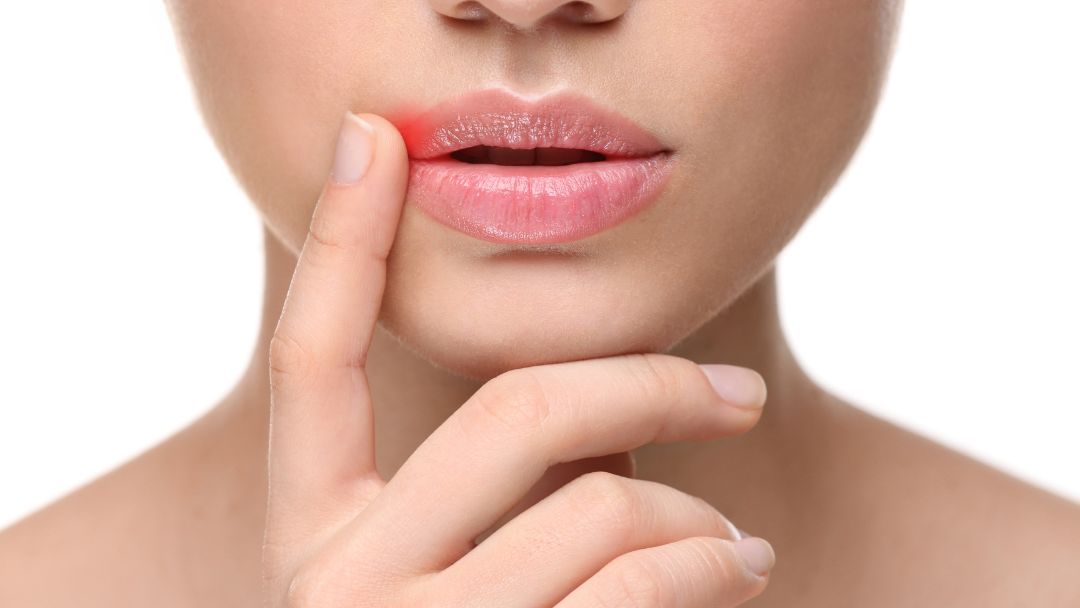 Cold sore on lip showing an early warning sign before a blister develops