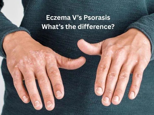 Eczema vs. Psoriasis: Key Differences, Symptoms, Causes, and Effective Treatments