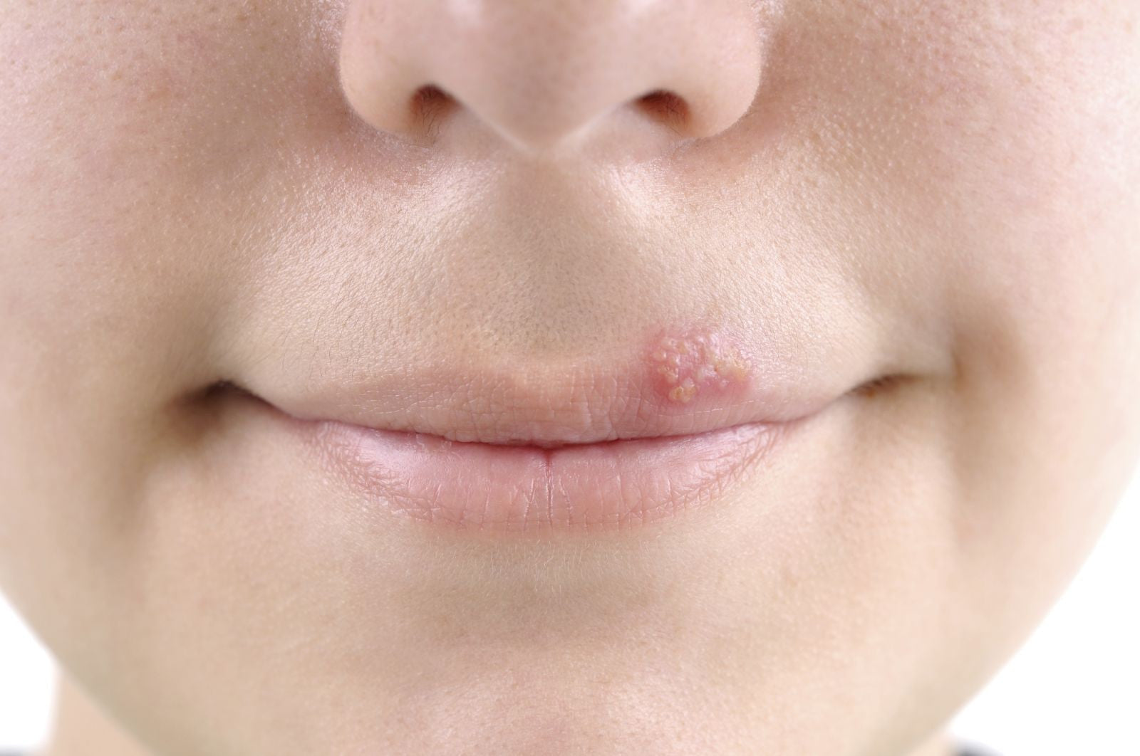 cold sore on the lip