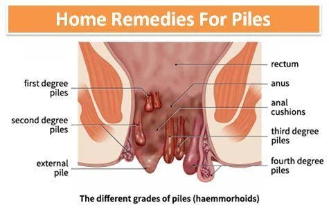 Haemorrhoids and Piles