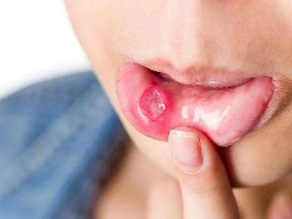 What are mouth Ulcers and how can they be treated?