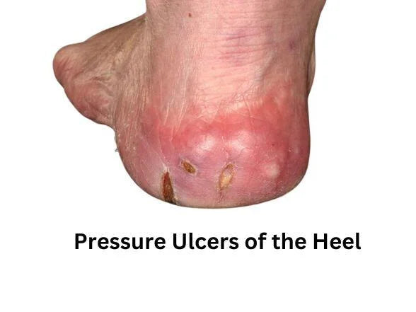 How to Prevent & Treat Pressure Ulcers on the Heel