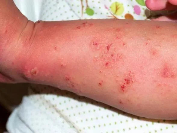 Effective Scabies Treatment: Guide to Using Lyclear Dermal Cream