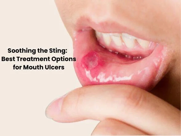 Say Goodbye to Mouth Ulcers: Exploring the Causes and unveiling the Best Treatment Option