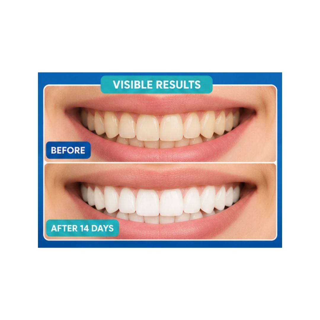 Beam Teeth Whitening Strips Before and After image 