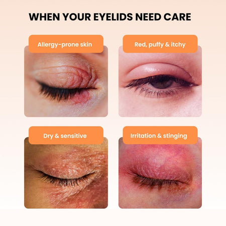 Illustrations of different eyelid conditions with text indicating when eyelid care is needed.