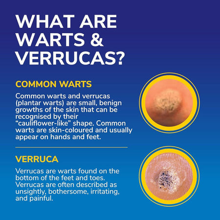 Educational graphic about warts and verrucas with images and text on a blue background
