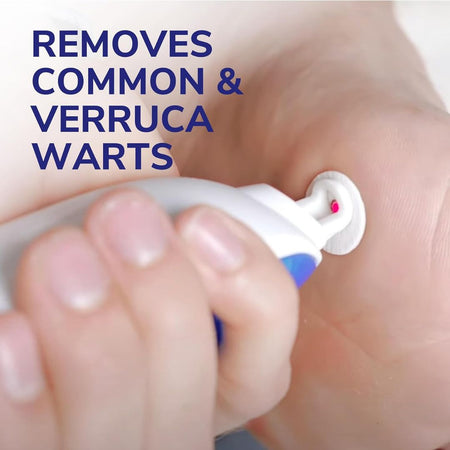 Foot with a device being used to remove warts, with text indicating wart removal capabilities.