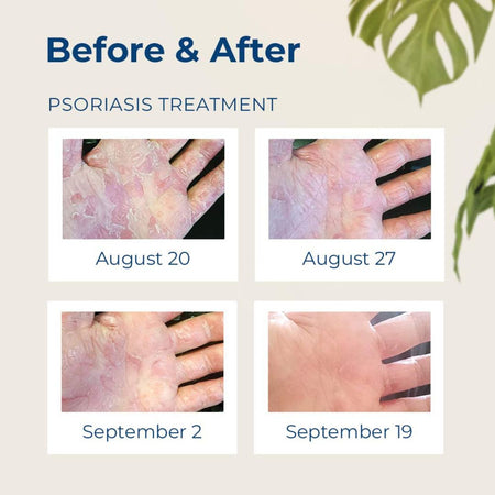 Before and after gloves in a bottle psoriasis treatment images on a beige background with a plant.
