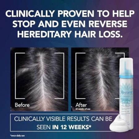Promotional graphic for a hair loss treatment bottle, with large text claiming clinical proven results to stop and reverse hereditary hair loss. Two before/after hair scalp photos are shown, alongside a white and light blue bottle and a dollop of cream on a dark blue background.