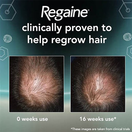 Advertisement for Regaine showing before and after hair growth results.
