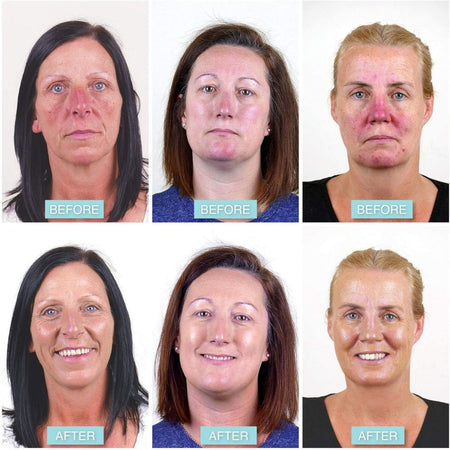 Before and after comparison of a woman's face with visible skin improvement after using Rosalique anti redness